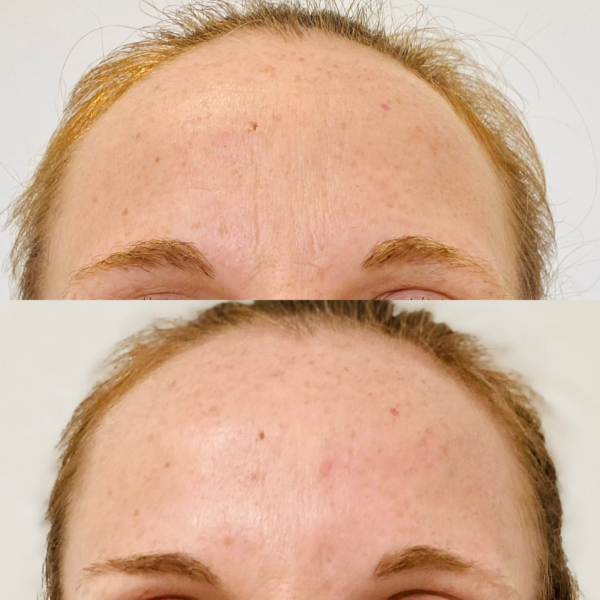 Botox & Hyaluronsäure Behandlung mit VorherNachher Fotos