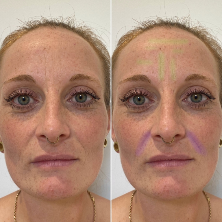 Botox & Hyaluronsäure Behandlung mit VorherNachher Fotos